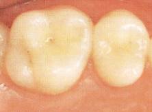 Okklusalfläche von zwei Zähnen mit tiefen Fissuren
